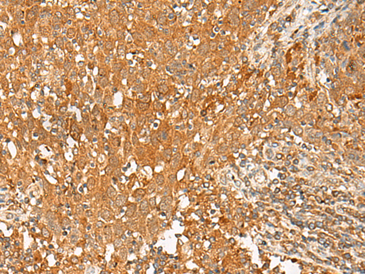 Immunohistochemistry of paraffin-embedded Human cervical cancer tissue  using GPR1 Polyclonal Antibody at dilution of 1:50(×200)