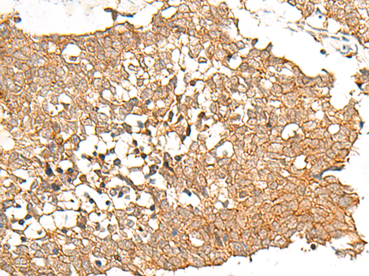Immunohistochemistry of paraffin-embedded Human lung cancer tissue  using PRLHR Polyclonal Antibody at dilution of 1:70(×200)