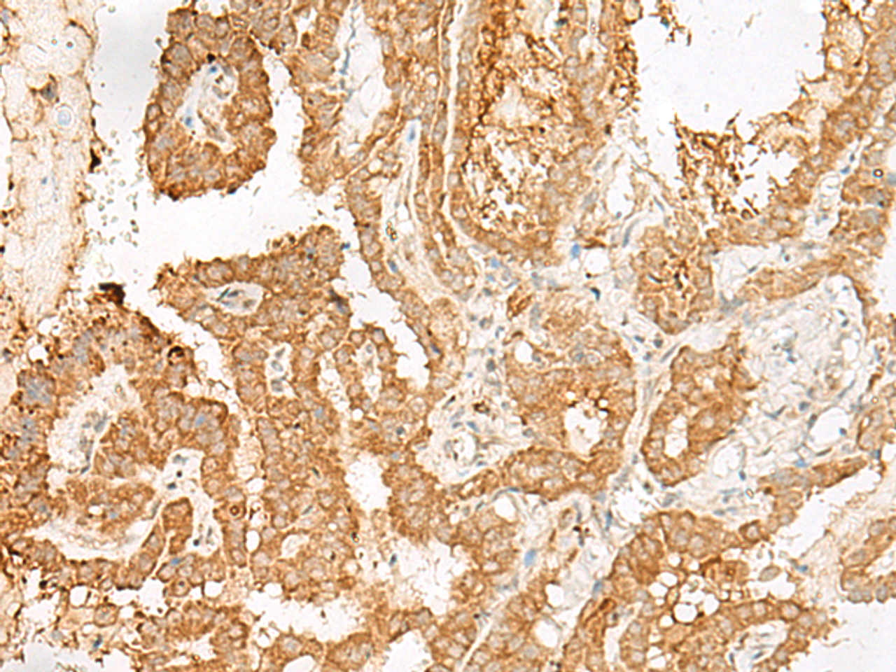 Immunohistochemistry of paraffin-embedded Human thyroid cancer tissue  using ADGRF1 Polyclonal Antibody at dilution of 1:25(×200)