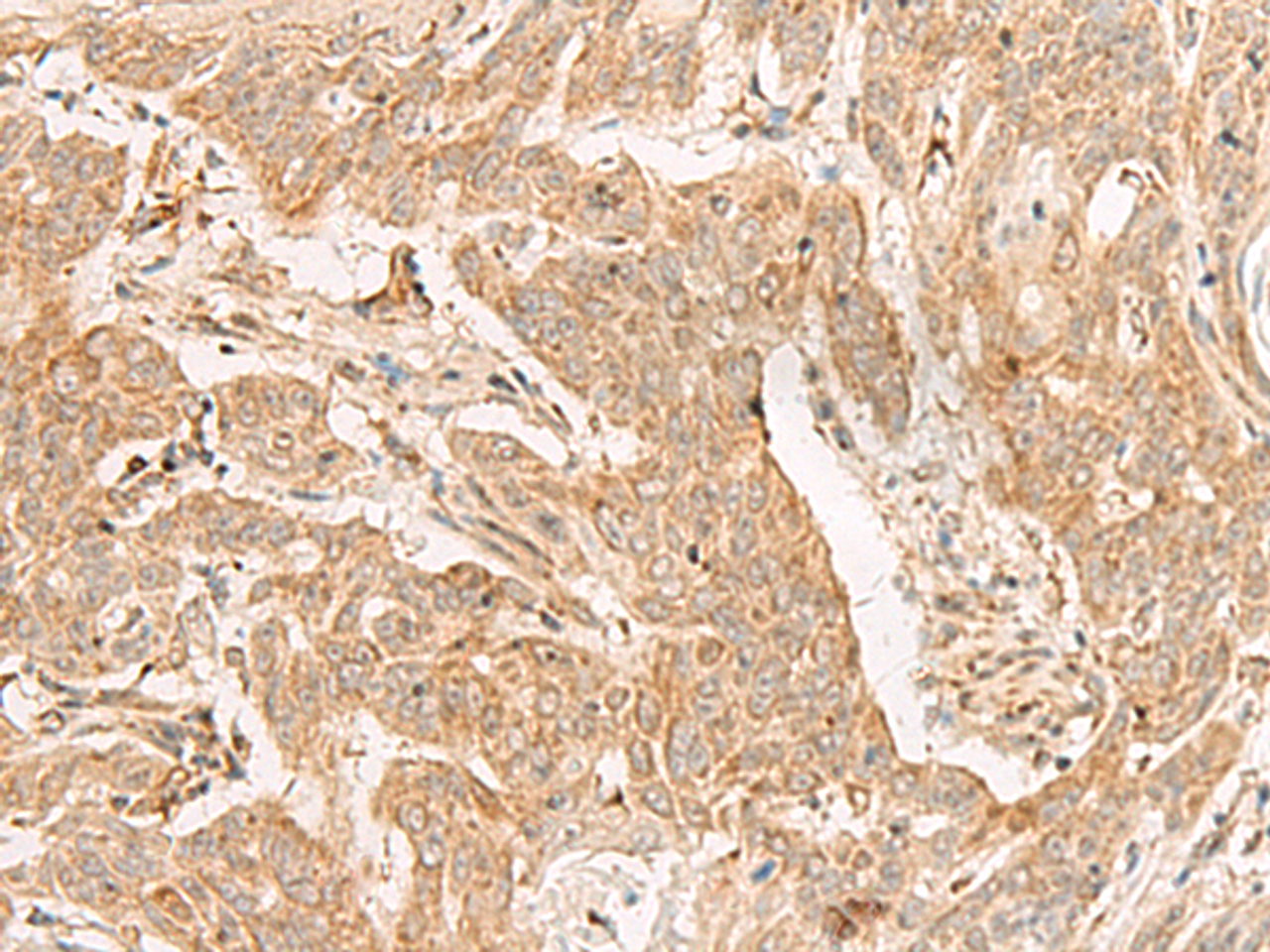 Immunohistochemistry of paraffin-embedded Human esophagus cancer tissue  using ADGRF1 Polyclonal Antibody at dilution of 1:25(×200)