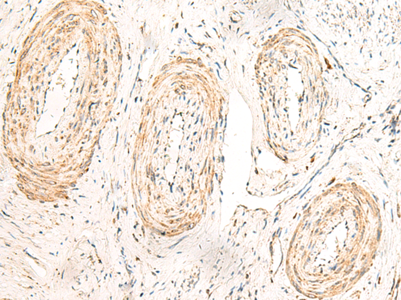 Immunohistochemistry of paraffin-embedded Human cervical cancer tissue  using GPR160 Polyclonal Antibody at dilution of 1:35(×200)