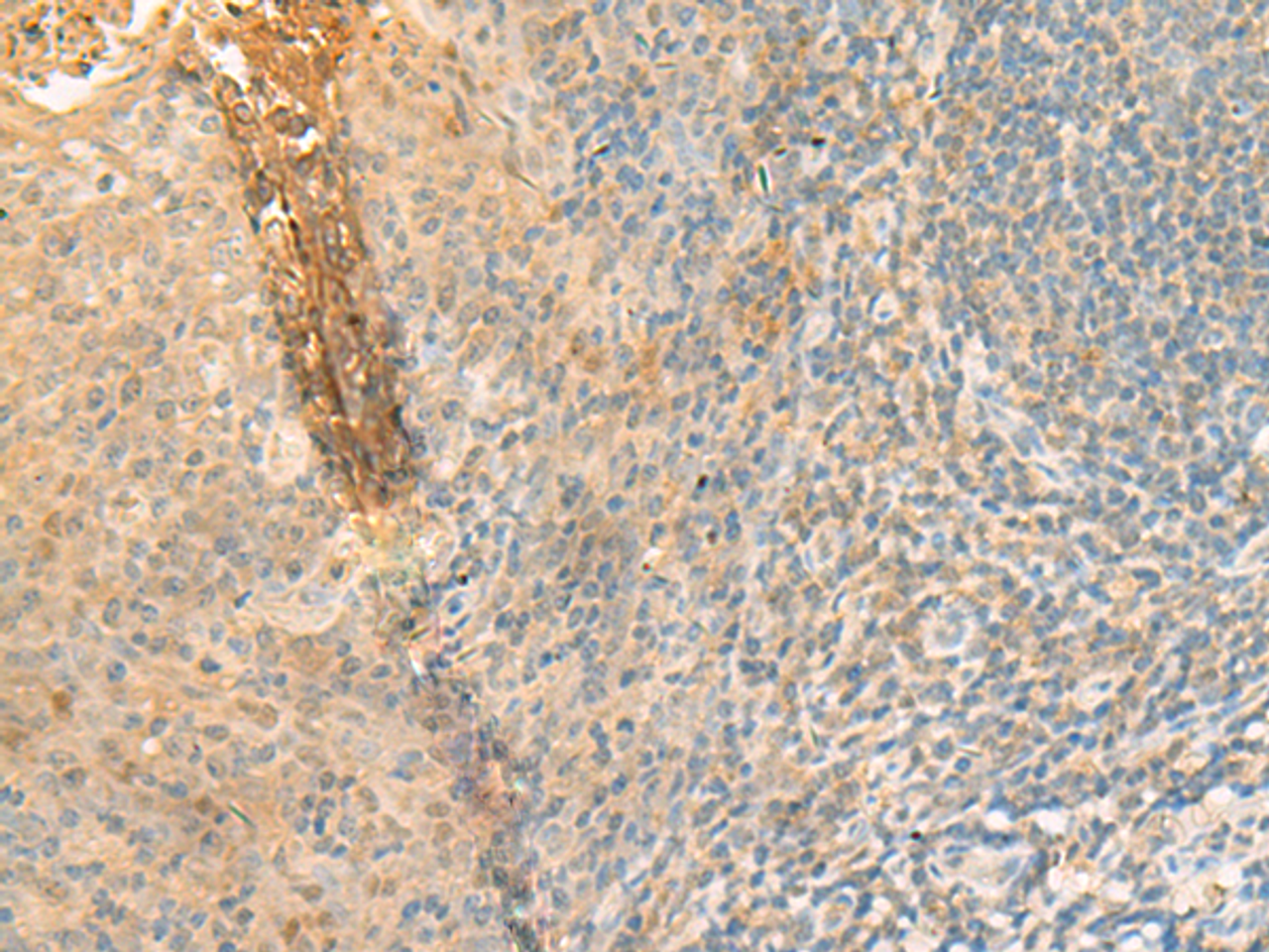 Immunohistochemistry of paraffin-embedded Human tonsil tissue  using GPT2 Polyclonal Antibody at dilution of 1:70(×200)