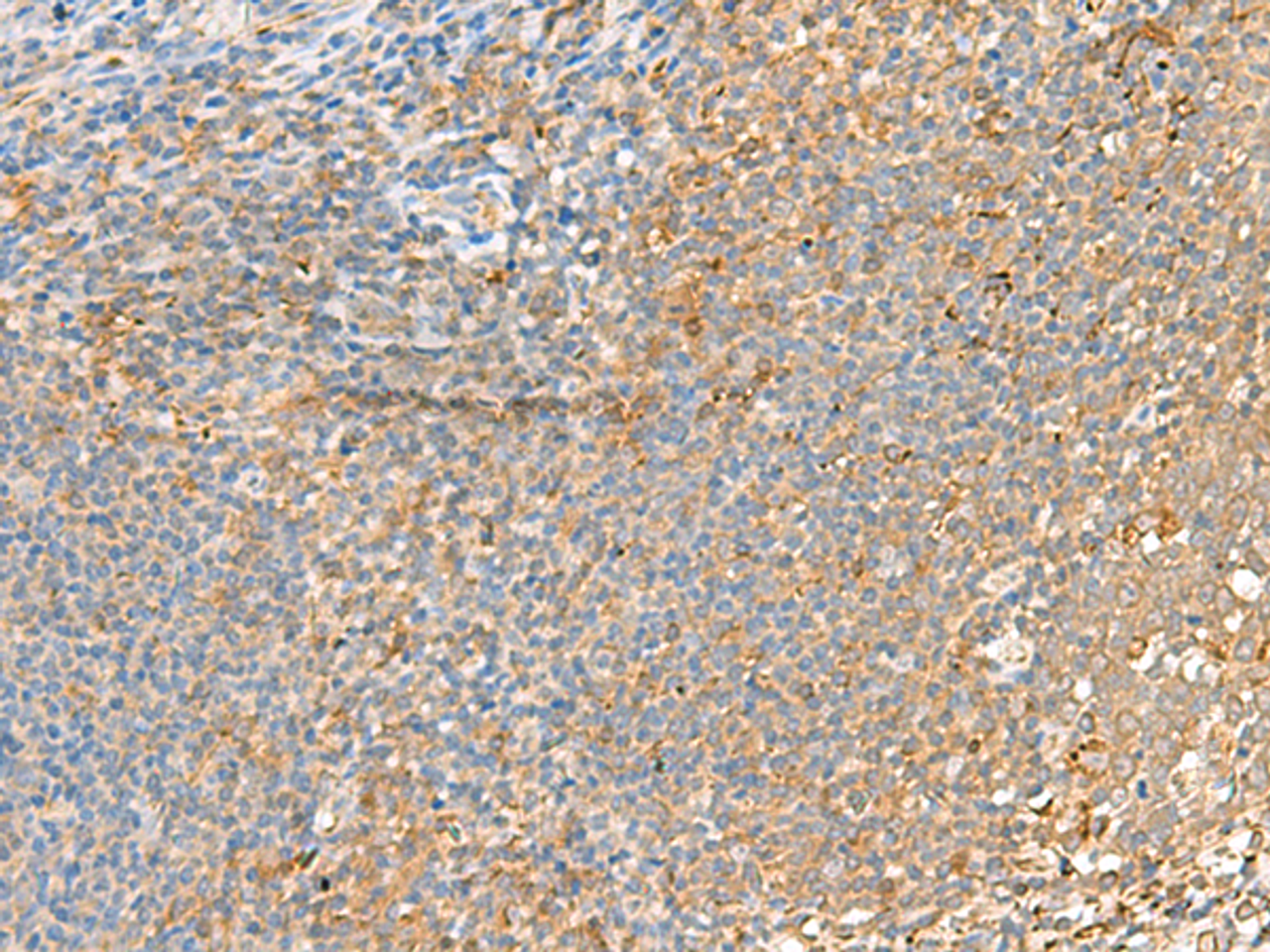 Immunohistochemistry of paraffin-embedded Human tonsil tissue  using GRIK2 Polyclonal Antibody at dilution of 1:55(×200)