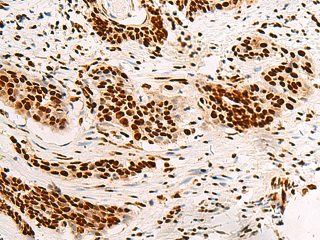 Immunohistochemistry of paraffin-embedded Human esophagus cancer tissue  using HNRNPA3 Polyclonal Antibody at dilution of 1:45(×200)