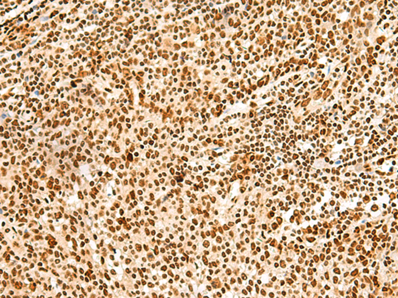 Immunohistochemistry of paraffin-embedded Human tonsil tissue  using HNRNPA3 Polyclonal Antibody at dilution of 1:45(×200)