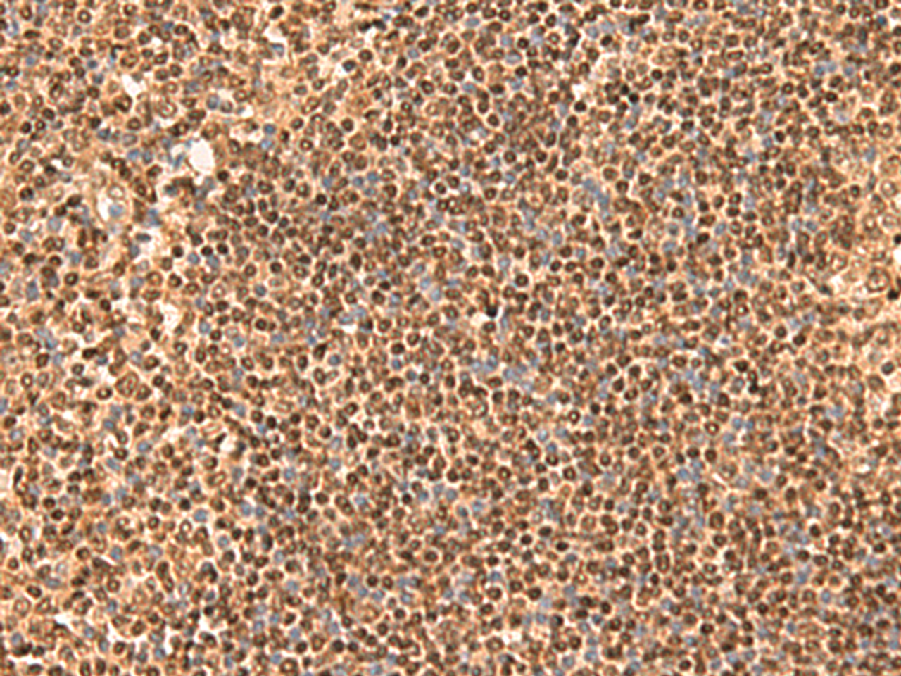 Immunohistochemistry of paraffin-embedded Human tonsil tissue  using SIX6 Polyclonal Antibody at dilution of 1:50(×200)