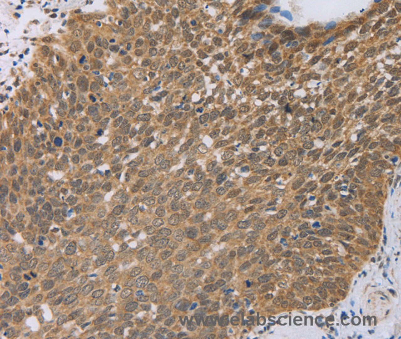 Immunohistochemistry of paraffin-embedded Human cervical cancer using PCP4 Polyclonal Antibody at dilution of 1:50