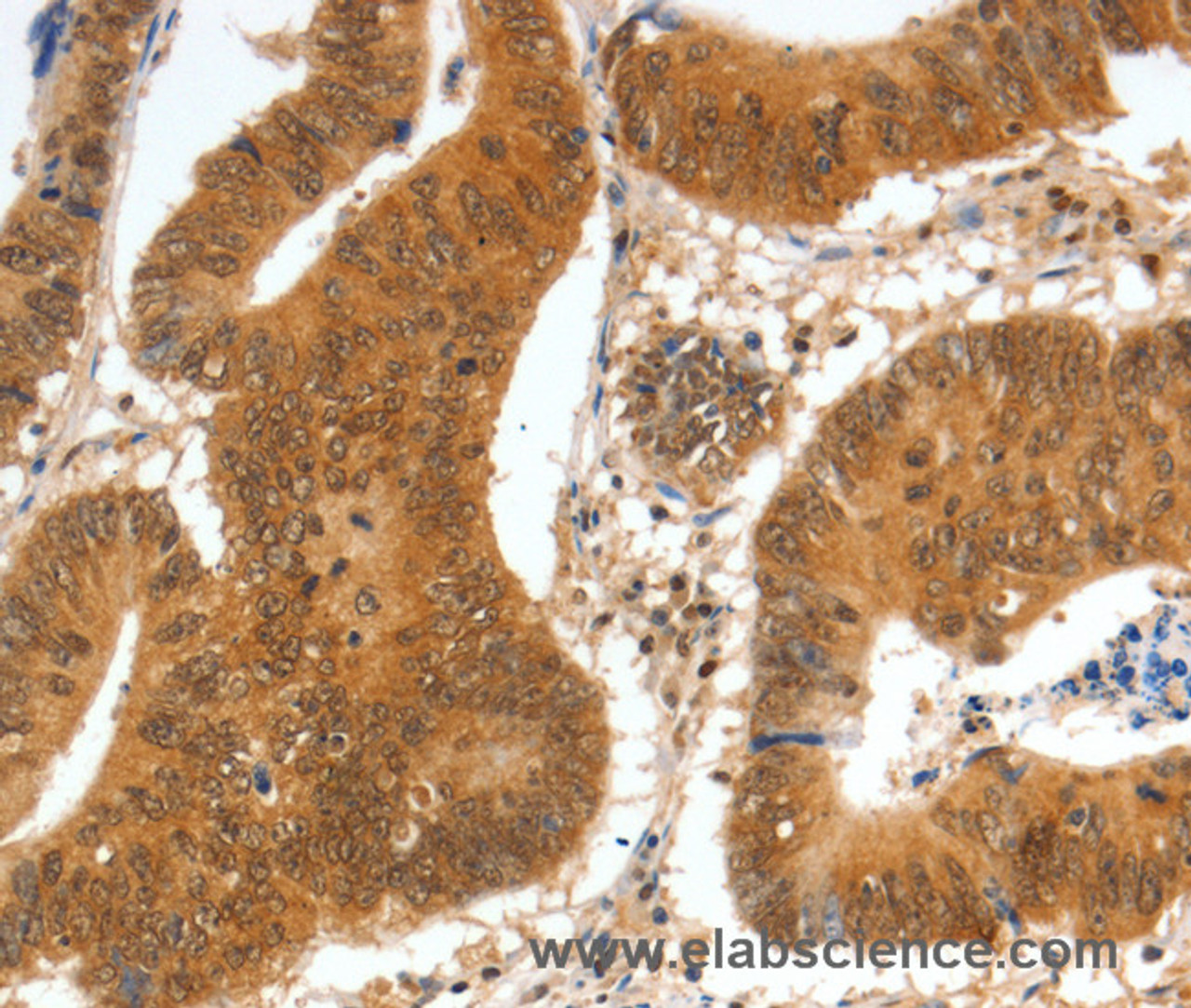 Immunohistochemistry of paraffin-embedded Human colon cancer tissue using SPDEF Polyclonal Antibody at dilution 1:60