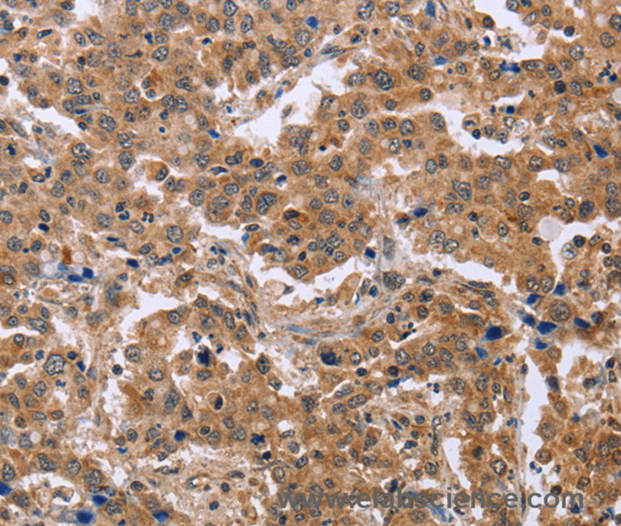 Immunohistochemistry of paraffin-embedded Human liver cancer using EPDR1 Polyclonal Antibody at dilution of 1:40
