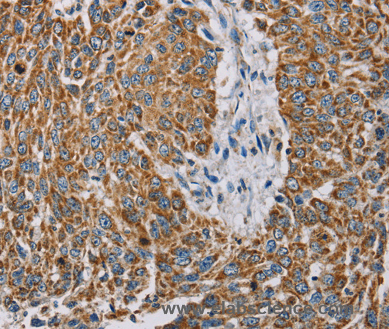 Immunohistochemistry of paraffin-embedded Human lung cancer using MTFP1 Polyclonal Antibody at dilution of 1:30