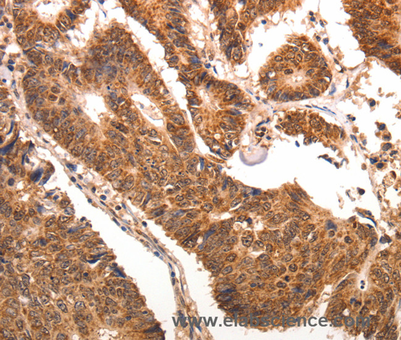 Immunohistochemistry of paraffin-embedded Human colon cancer using CCL17 Polyclonal Antibody at dilution of 1:70