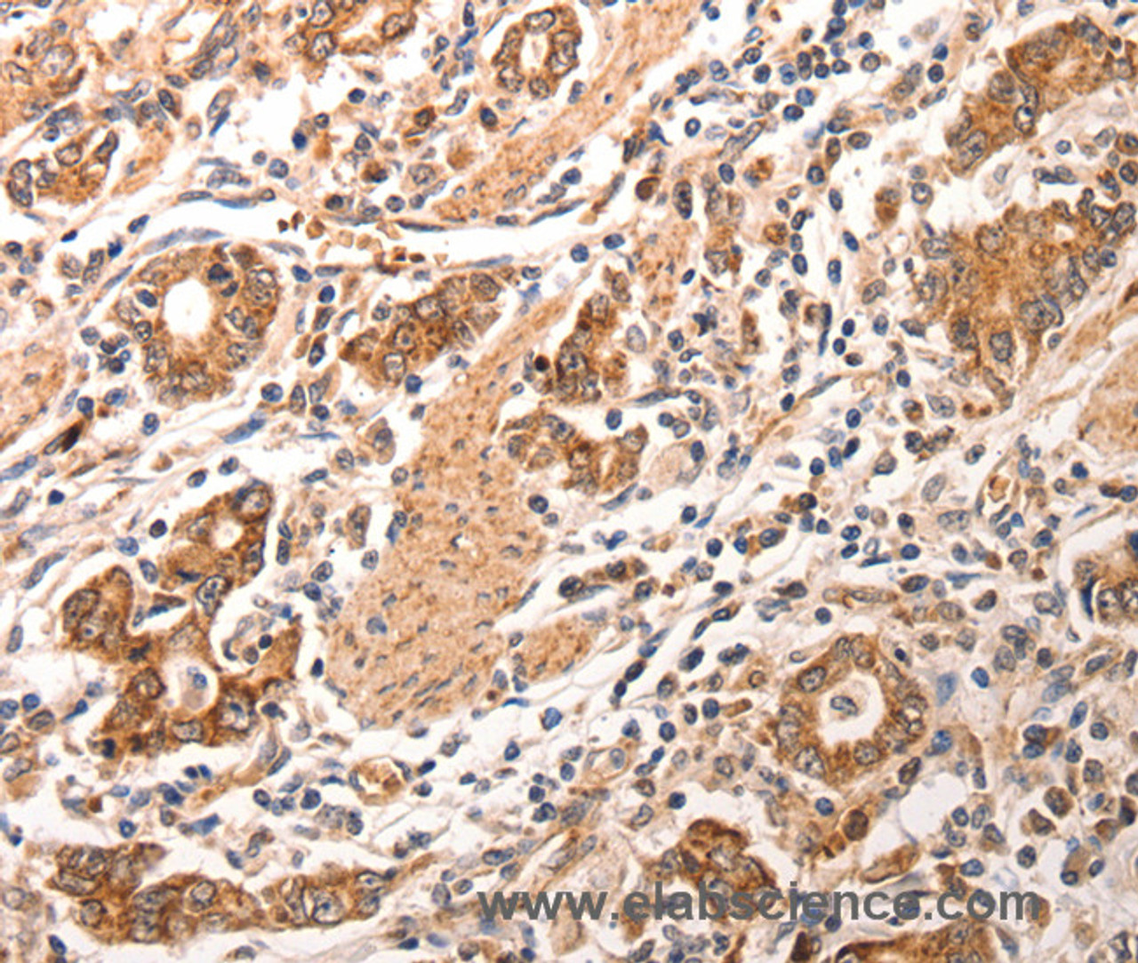 Immunohistochemistry of paraffin-embedded Human gastric cancer using CCL17 Polyclonal Antibody at dilution of 1:70