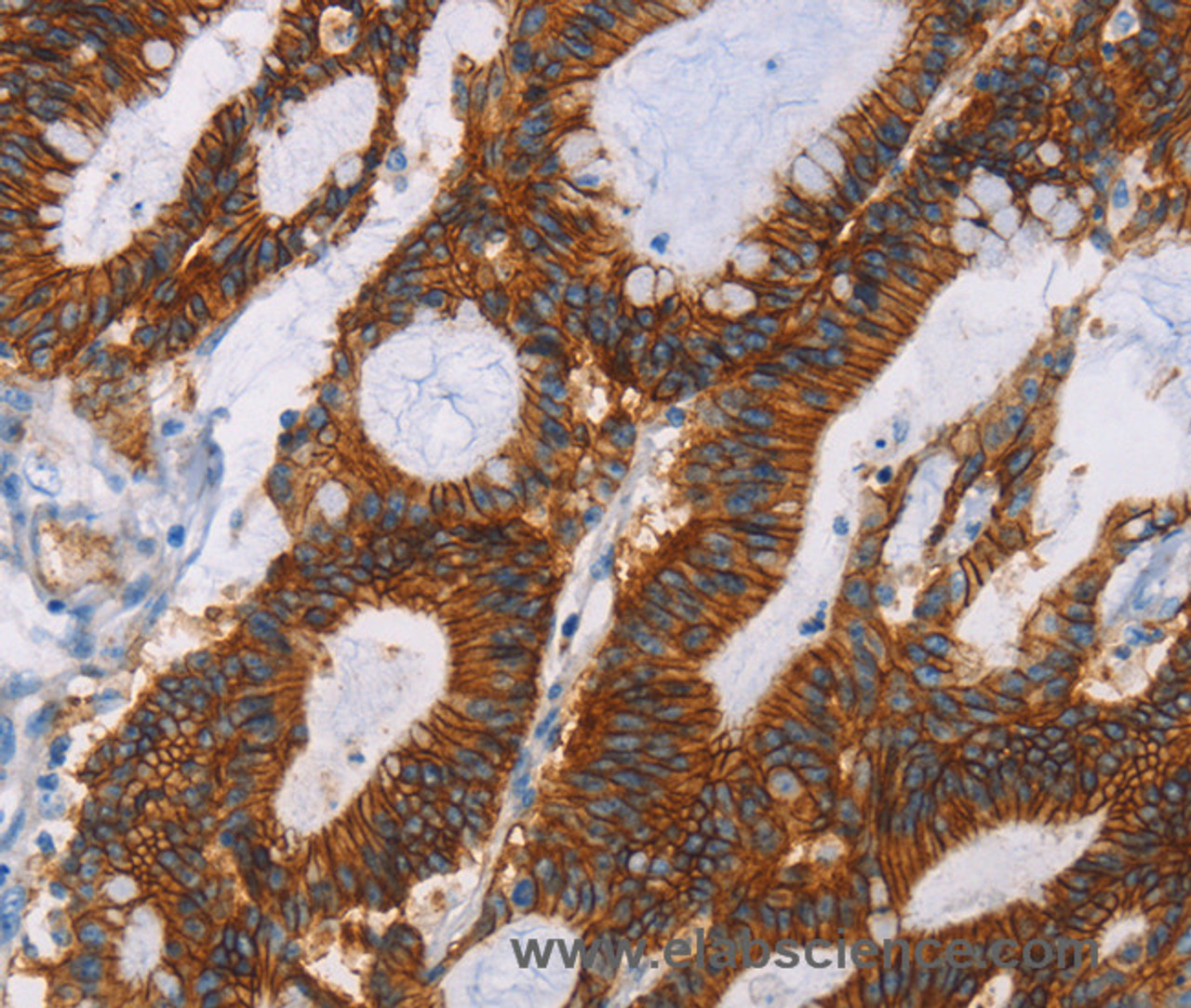 Immunohistochemistry of paraffin-embedded Human colon cancer using GPA33 Polyclonal Antibody at dilution of 1:30