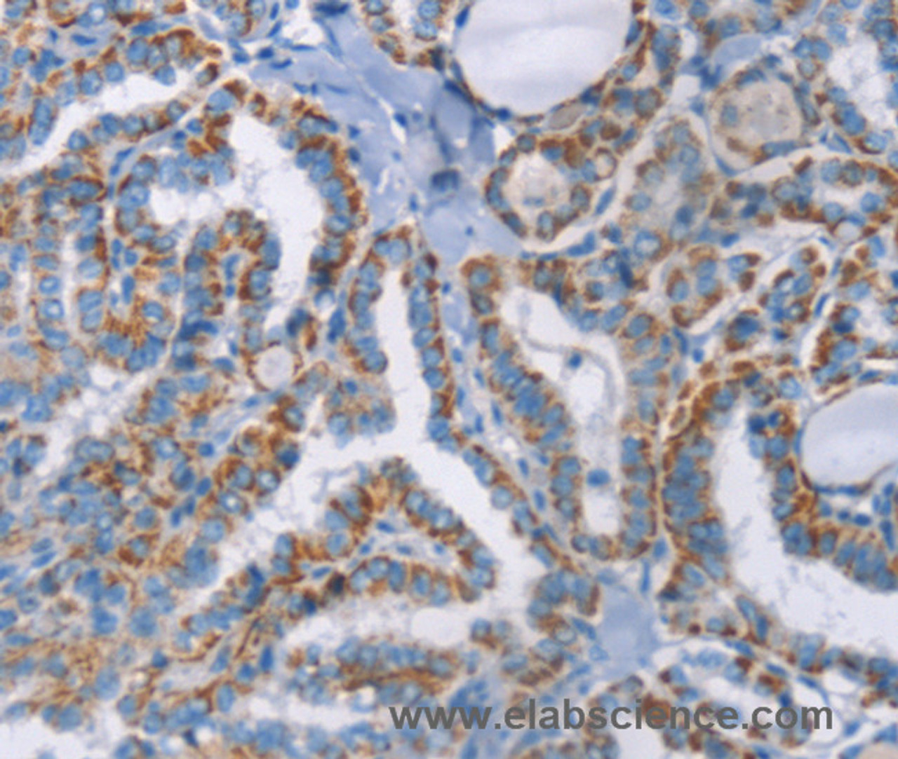 Immunohistochemistry of paraffin-embedded Human thyroid cancer using GPA33 Polyclonal Antibody at dilution of 1:30