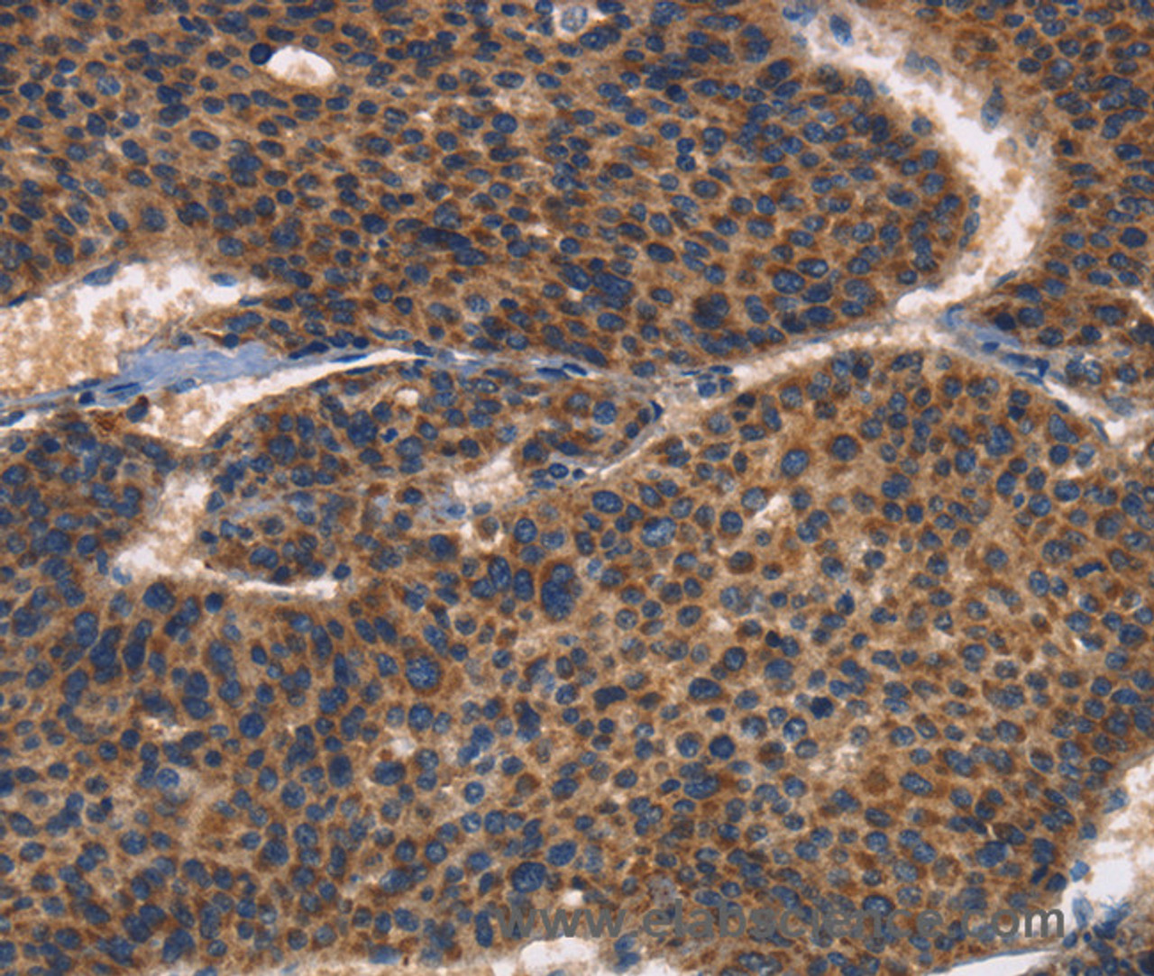 Immunohistochemistry of paraffin-embedded Human liver cancer using CD61 Polyclonal Antibody at dilution of 1:30