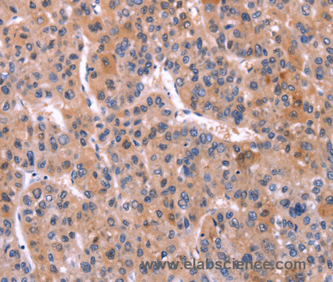 Immunohistochemistry of paraffin-embedded Human liver cancer using CD269 Polyclonal Antibody at dilution of 1:30