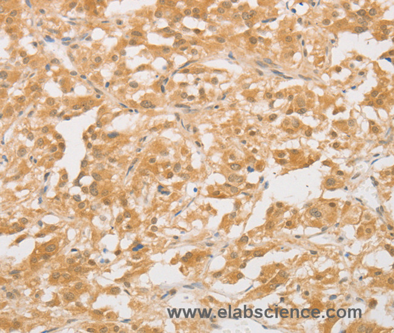 Immunohistochemistry of paraffin-embedded Human thyroid cancer tissue using CD24 Polyclonal Antibody at dilution of 1:40