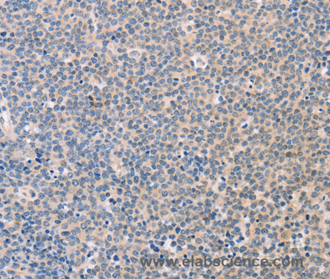 Immunohistochemistry of paraffin-embedded Human Lymphoma tissue using CD56 Polyclonal Antibody at dilution 1:30