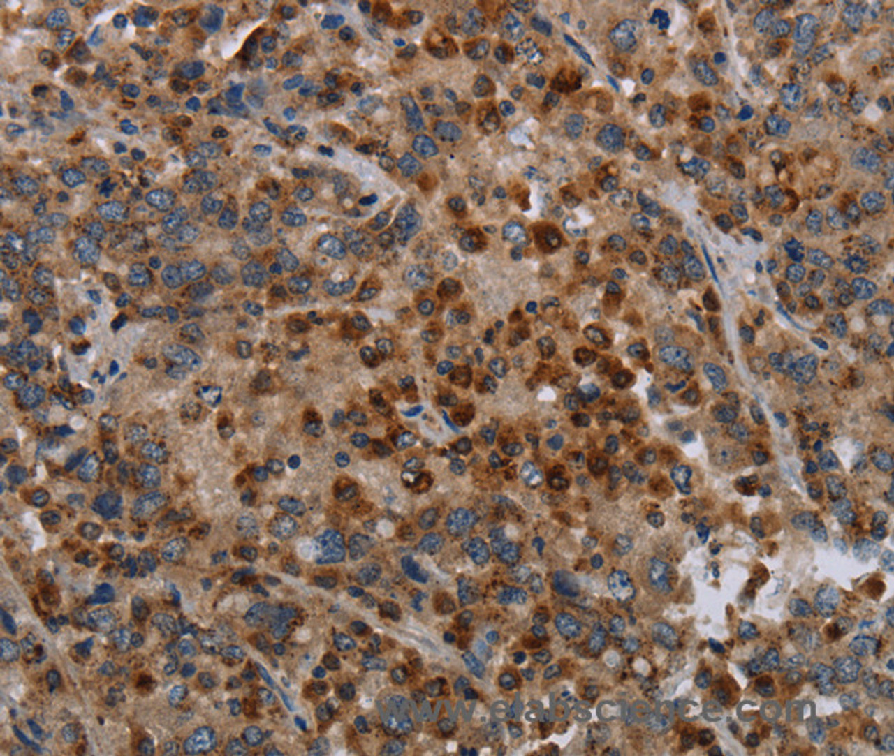 Immunohistochemistry of paraffin-embedded Human liver cancer using MAP3K11 Polyclonal Antibody at dilution of 1:40
