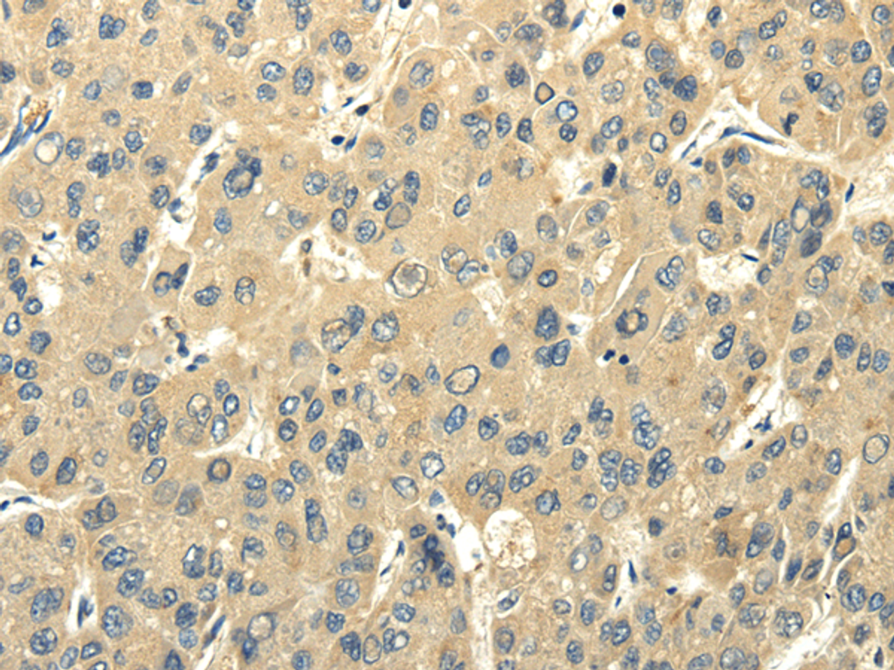 Immunohistochemistry of paraffin-embedded Human liver cancer using PMP2 Polyclonal Antibody at dilution of  1/25