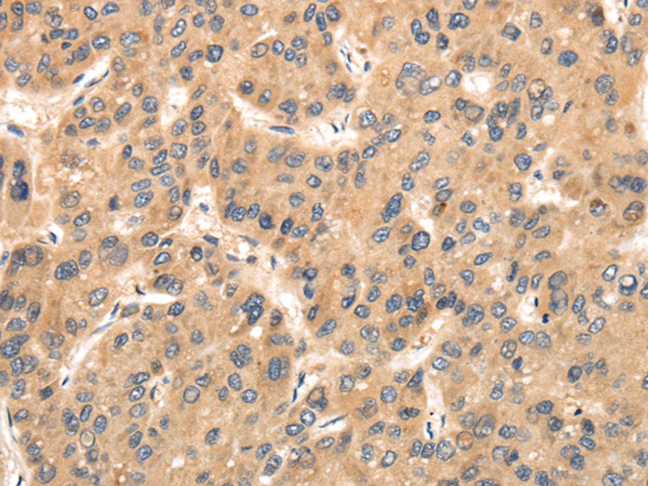 Immunohistochemistry of paraffin-embedded Human liver cancer using TTC23 Polyclonal Antibody at dilution of  1/35