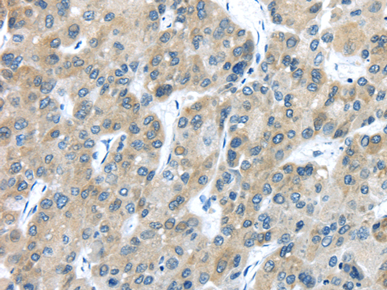Immunohistochemistry of paraffin-embedded Human liver cancer using TXNDC5 Polyclonal Antibody at dilution of  1/40