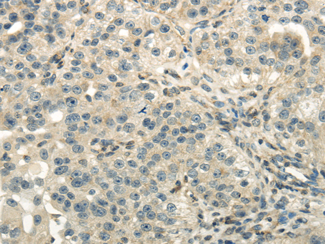 Immunohistochemistry of paraffin-embedded Human breast cancer using DLAT Polyclonal Antibody at dilution of  1/40