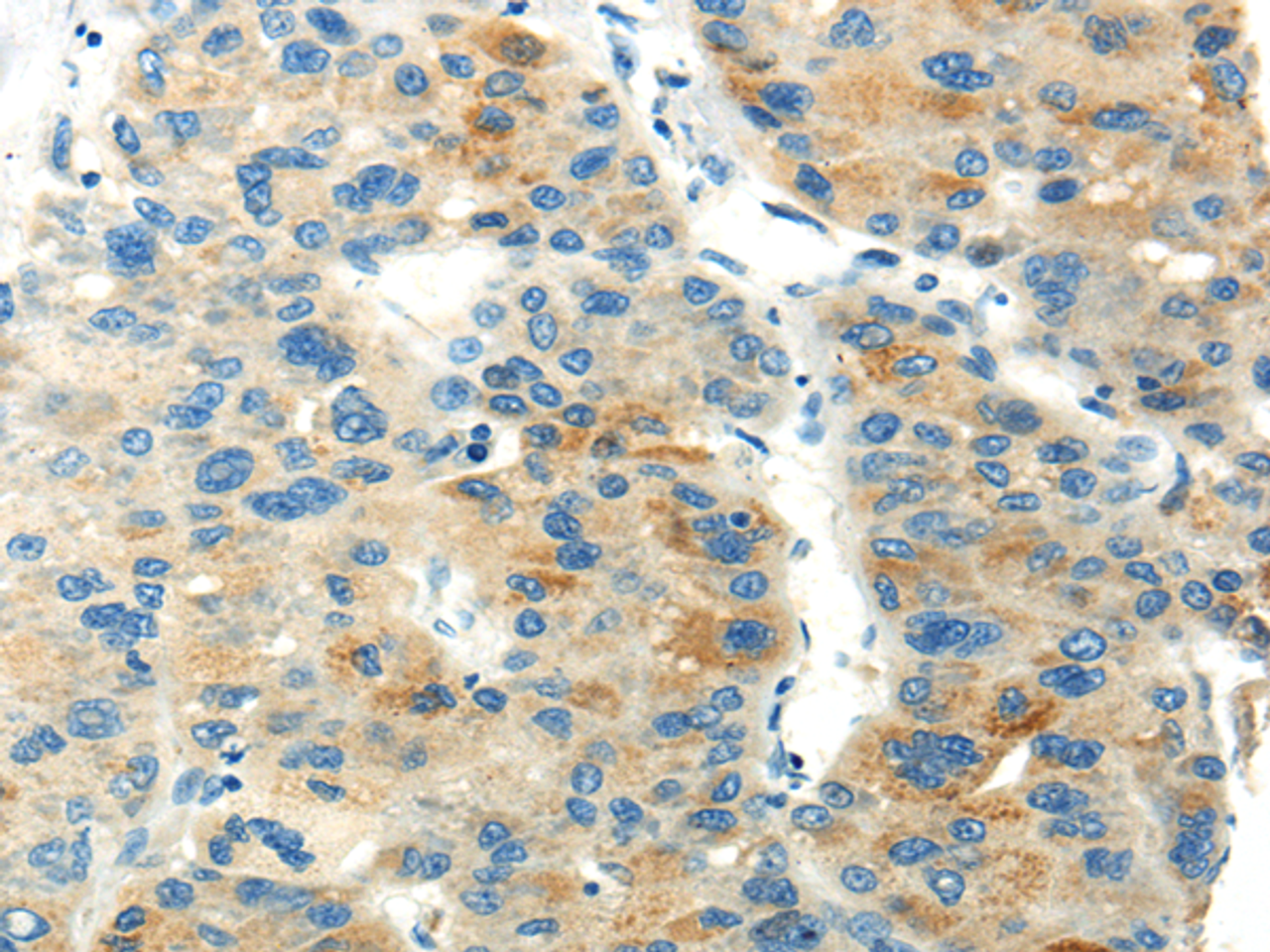 Immunohistochemistry of paraffin-embedded Human liver cancer using PDPN Polyclonal Antibody at dilution of  1/20