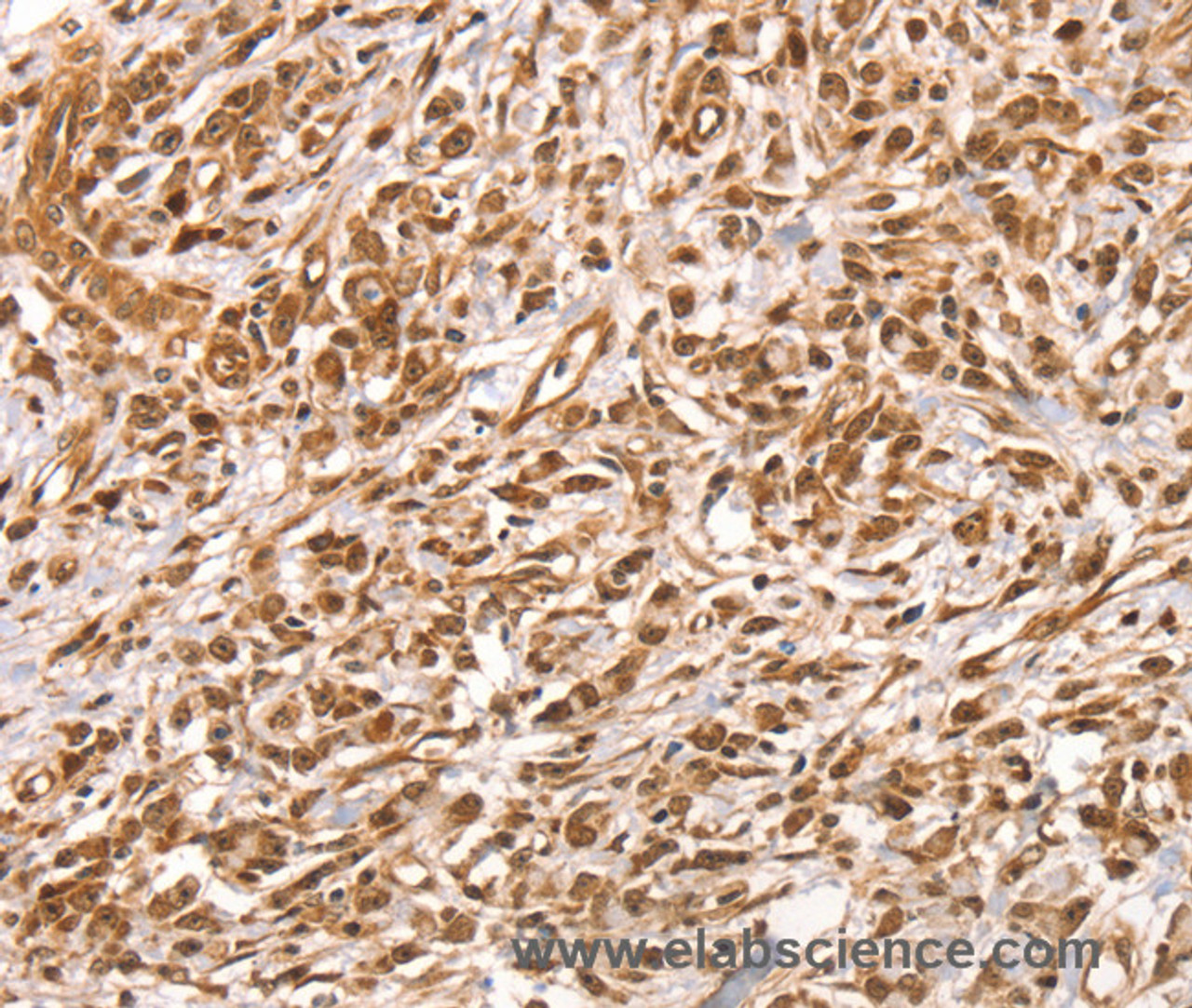 Immunohistochemistry of paraffin-embedded Human colon cancer using SUMO2/3/4 Polyclonal Antibody at dilution of 1:100