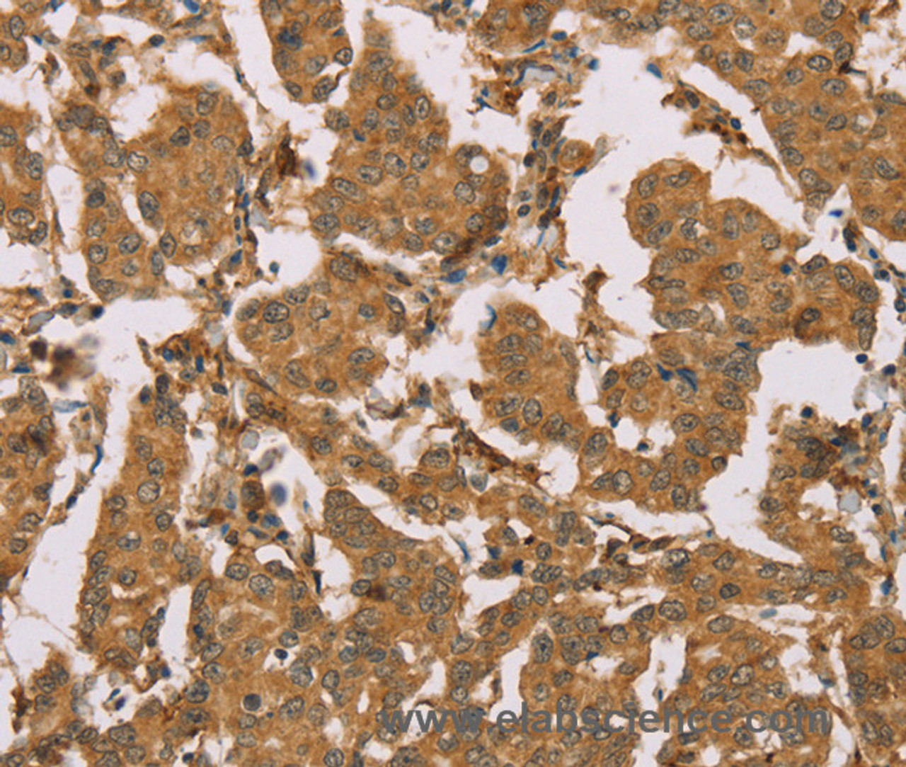 Immunohistochemistry of paraffin-embedded Human thyroid cancer using SUMO2/3/4 Polyclonal Antibody at dilution of 1:100