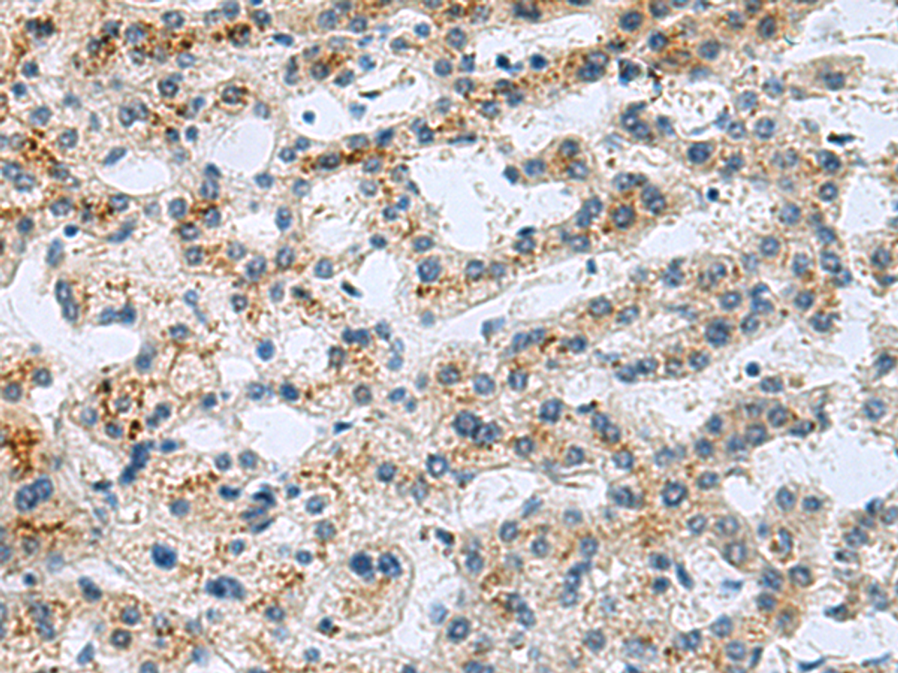 Immunohistochemistry of paraffin-embedded Human liver cancer tissue  using GHRHR Polyclonal Antibody at dilution of 1:40(×200)