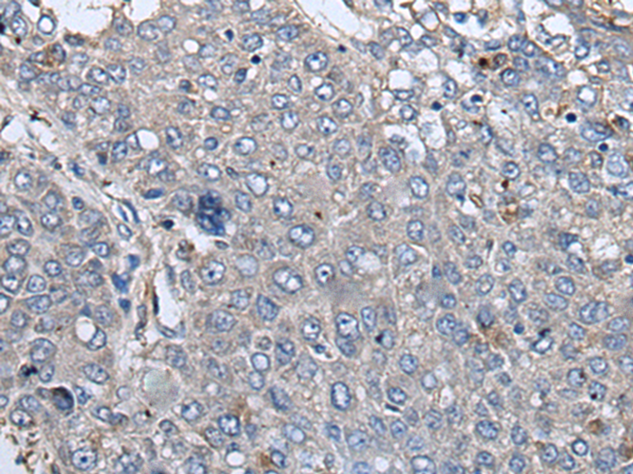 Immunohistochemistry of paraffin-embedded Human liver cancer tissue  using RIPK1 Polyclonal Antibody at dilution of 1:85(×200)