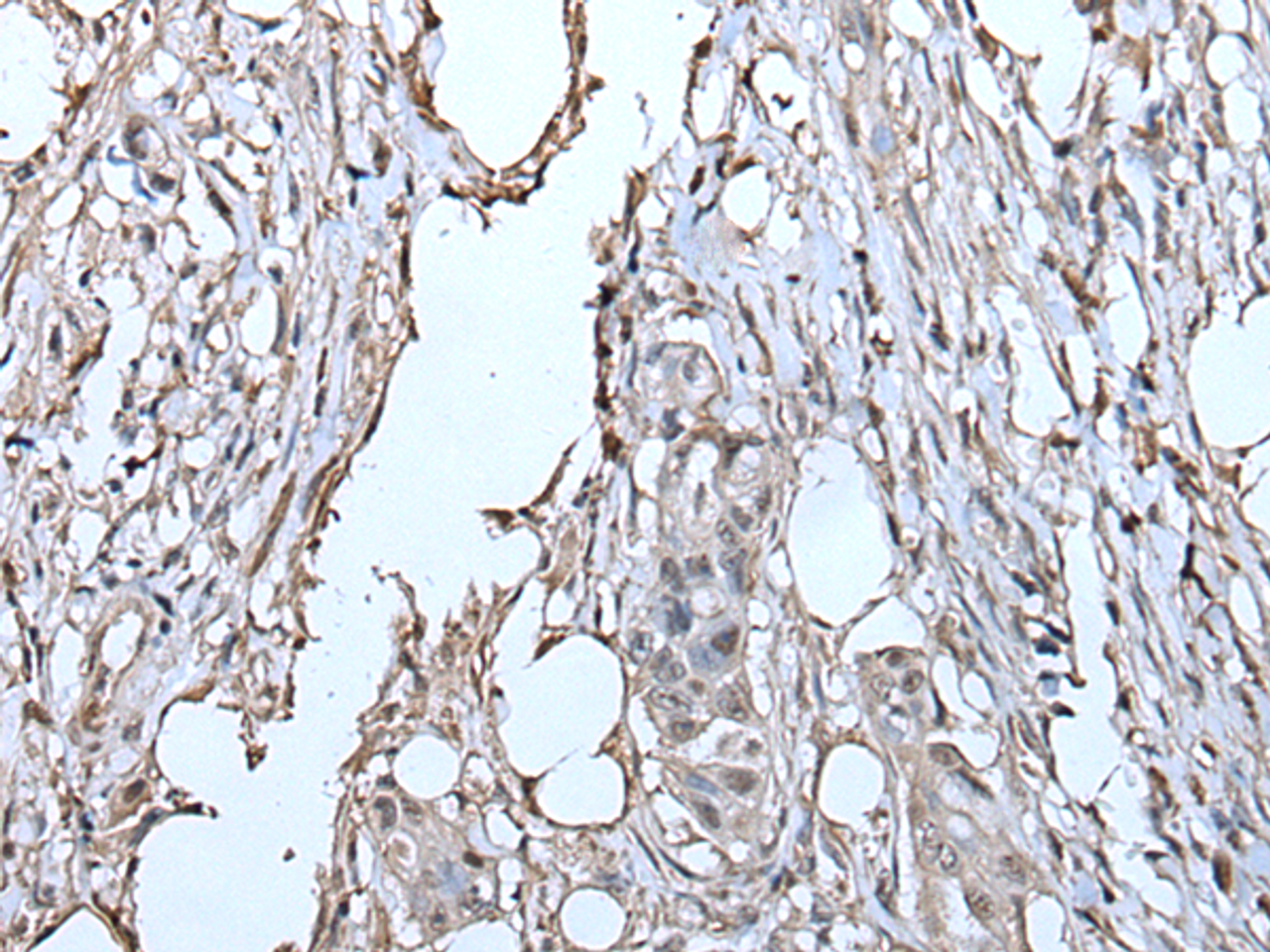 Immunohistochemistry of paraffin-embedded Human colorectal cancer tissue  using TPT1 Polyclonal Antibody at dilution of 1:85(×200)