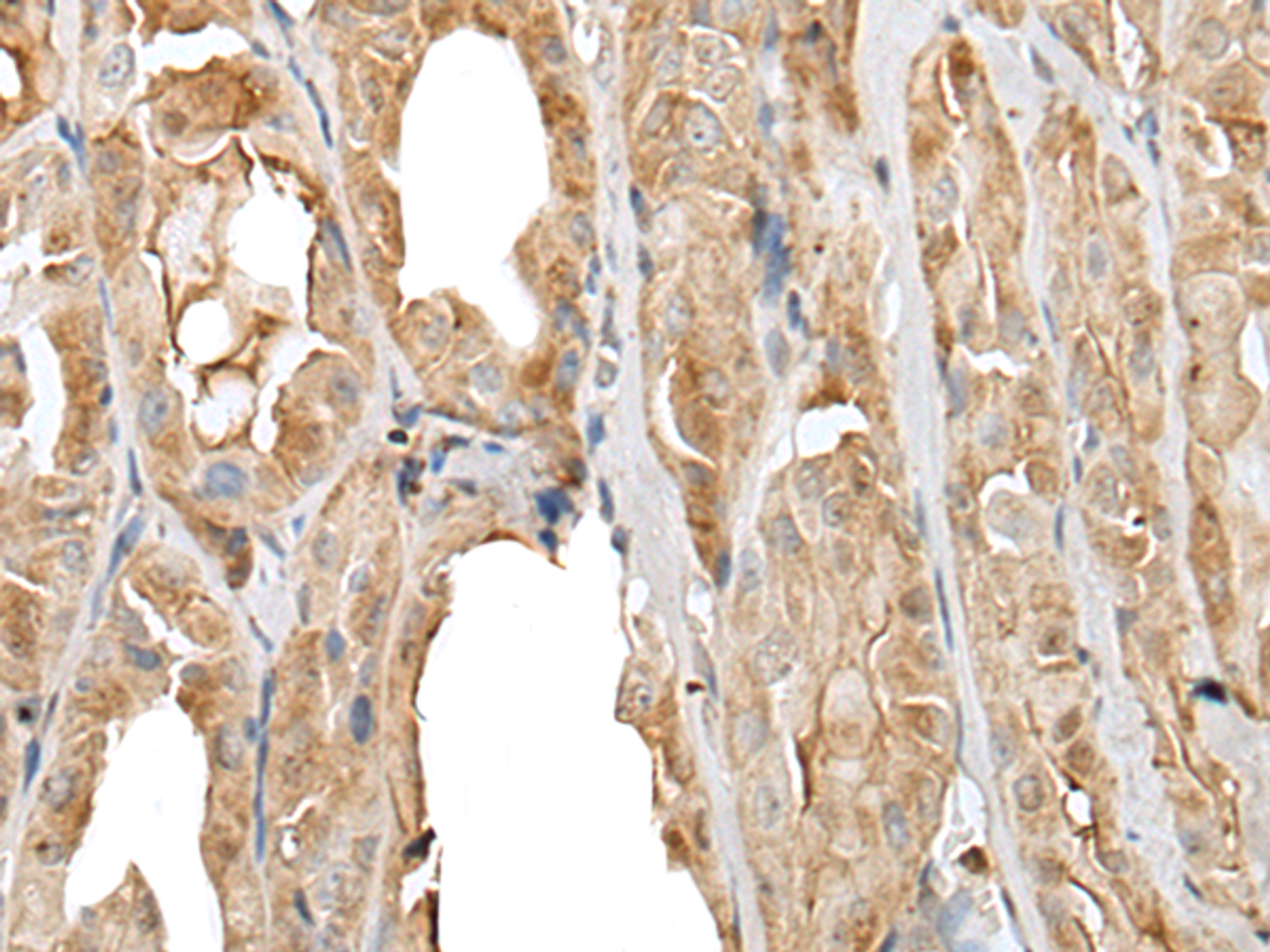 Immunohistochemistry of paraffin-embedded Human thyroid cancer tissue  using PRNP Polyclonal Antibody at dilution of 1:45(×200)