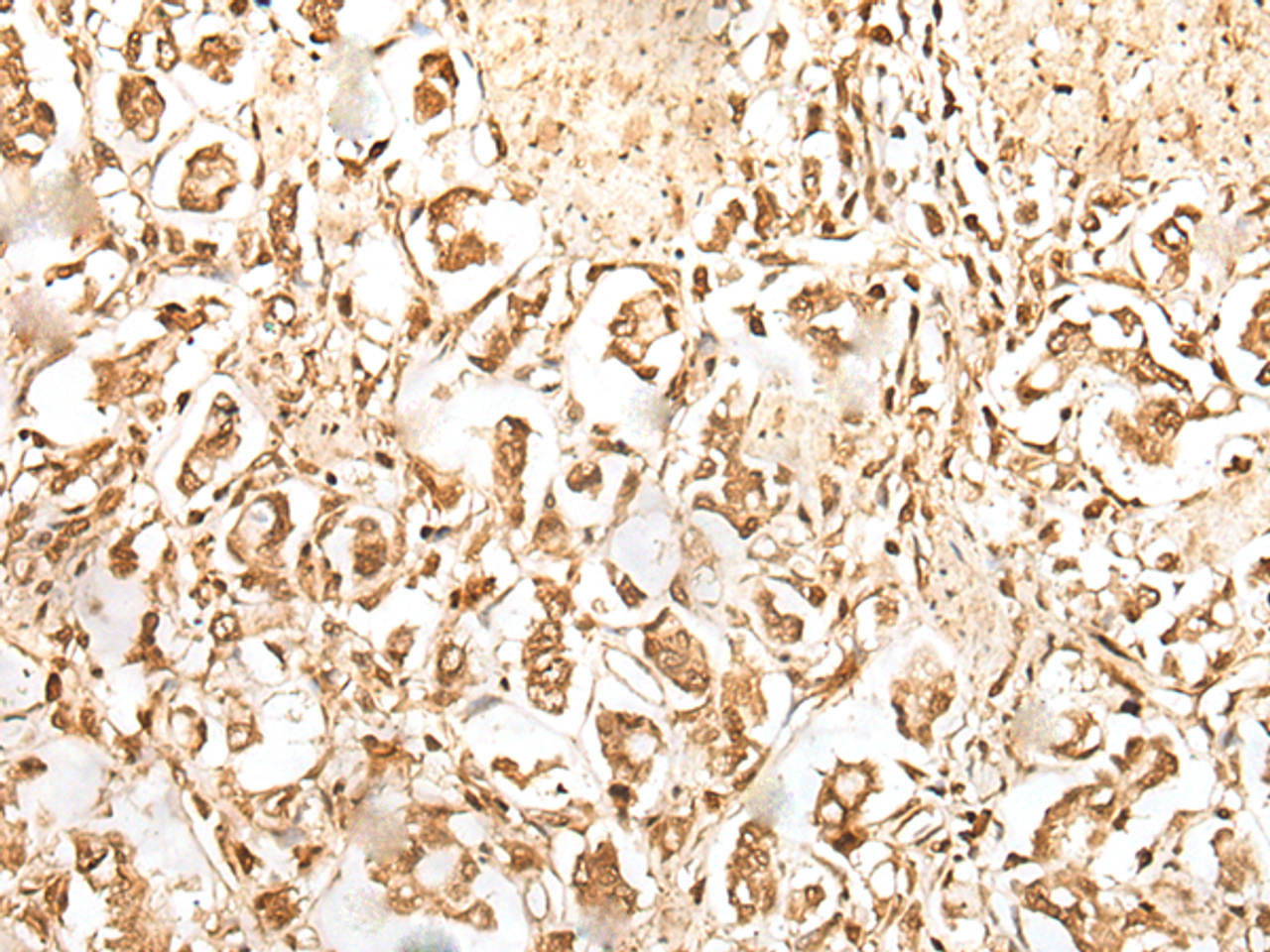 Immunohistochemistry of paraffin-embedded Human gastric cancer tissue  using ZUFSP Polyclonal Antibody at dilution of 1:35(×200)