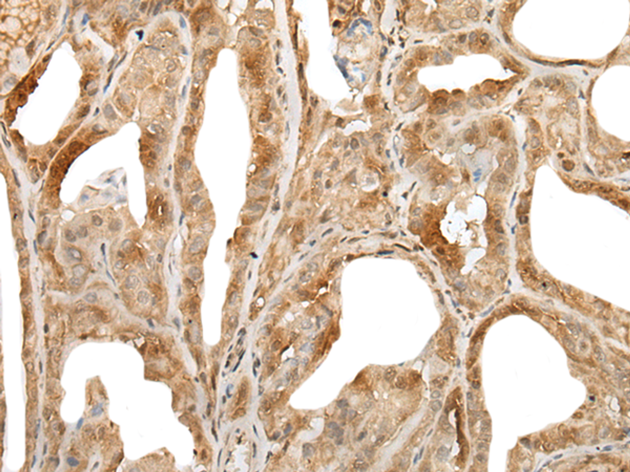 Immunohistochemistry of paraffin-embedded Human thyroid cancer tissue  using ZUFSP Polyclonal Antibody at dilution of 1:35(×200)