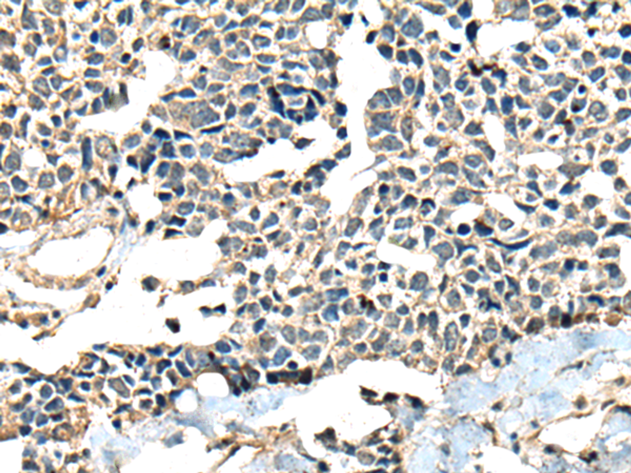 Immunohistochemistry of paraffin-embedded Human lung cancer tissue  using CALHM1 Polyclonal Antibody at dilution of 1:60(×200)