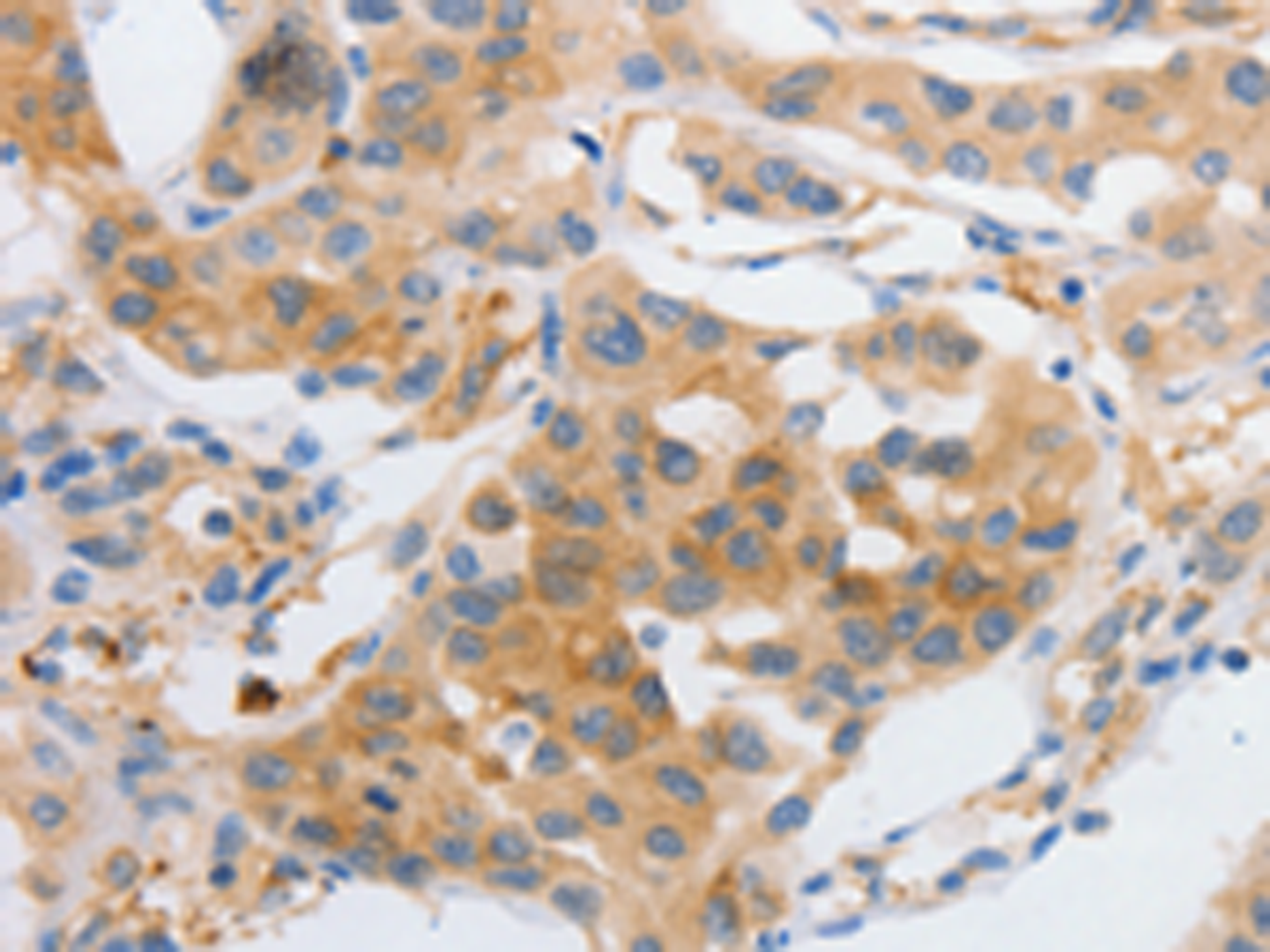Immunohistochemistry of paraffin-embedded Human lung cancer tissue  using MYOD1 Polyclonal Antibody at dilution of 1:120(×200)