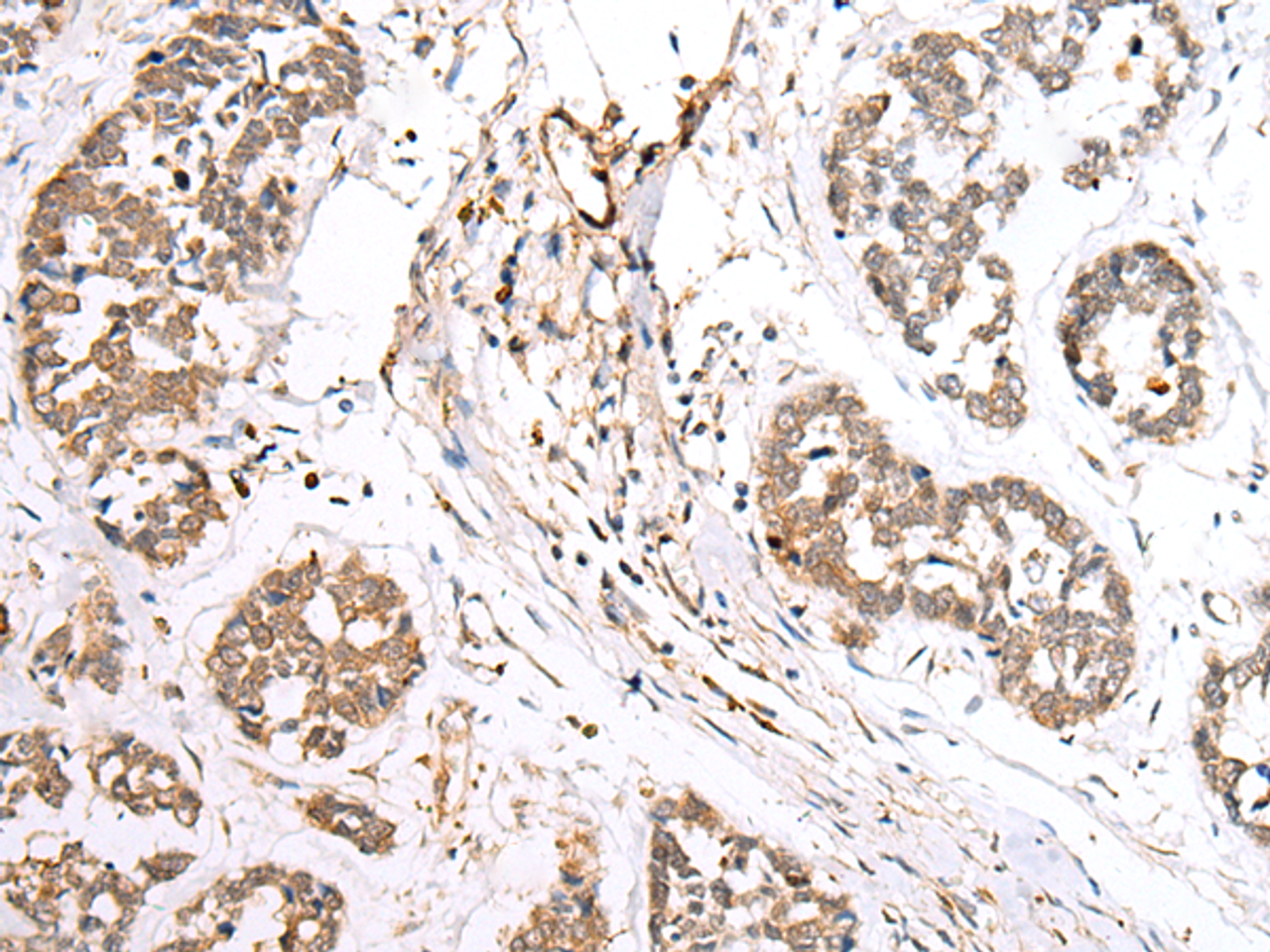 Immunohistochemistry of paraffin-embedded Human esophagus cancer tissue  using BAG2 Polyclonal Antibody at dilution of 1:40(×200)