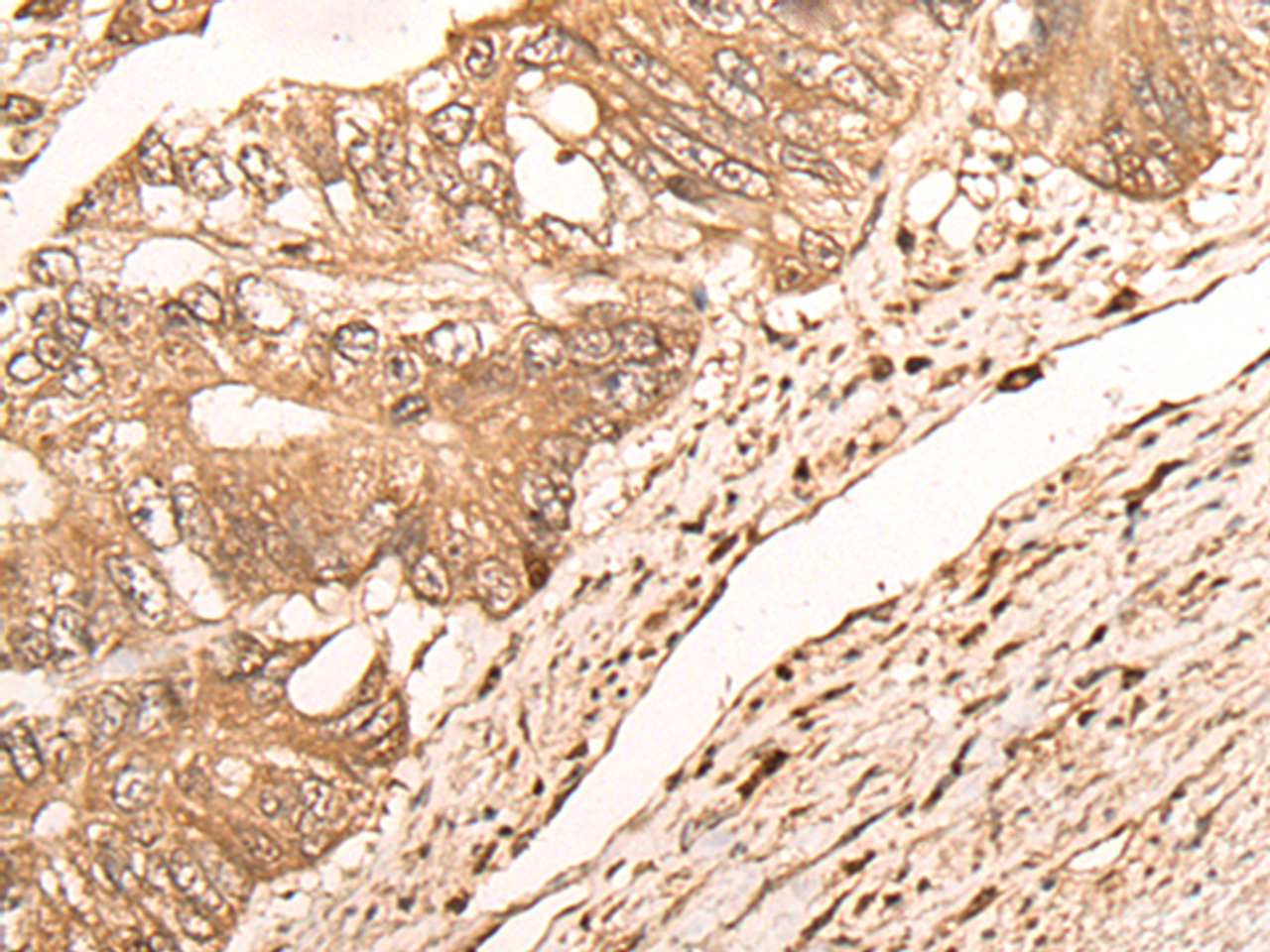 Immunohistochemistry of paraffin-embedded Human colorectal cancer tissue  using MAGEA1 Polyclonal Antibody at dilution of 1:65(×200)
