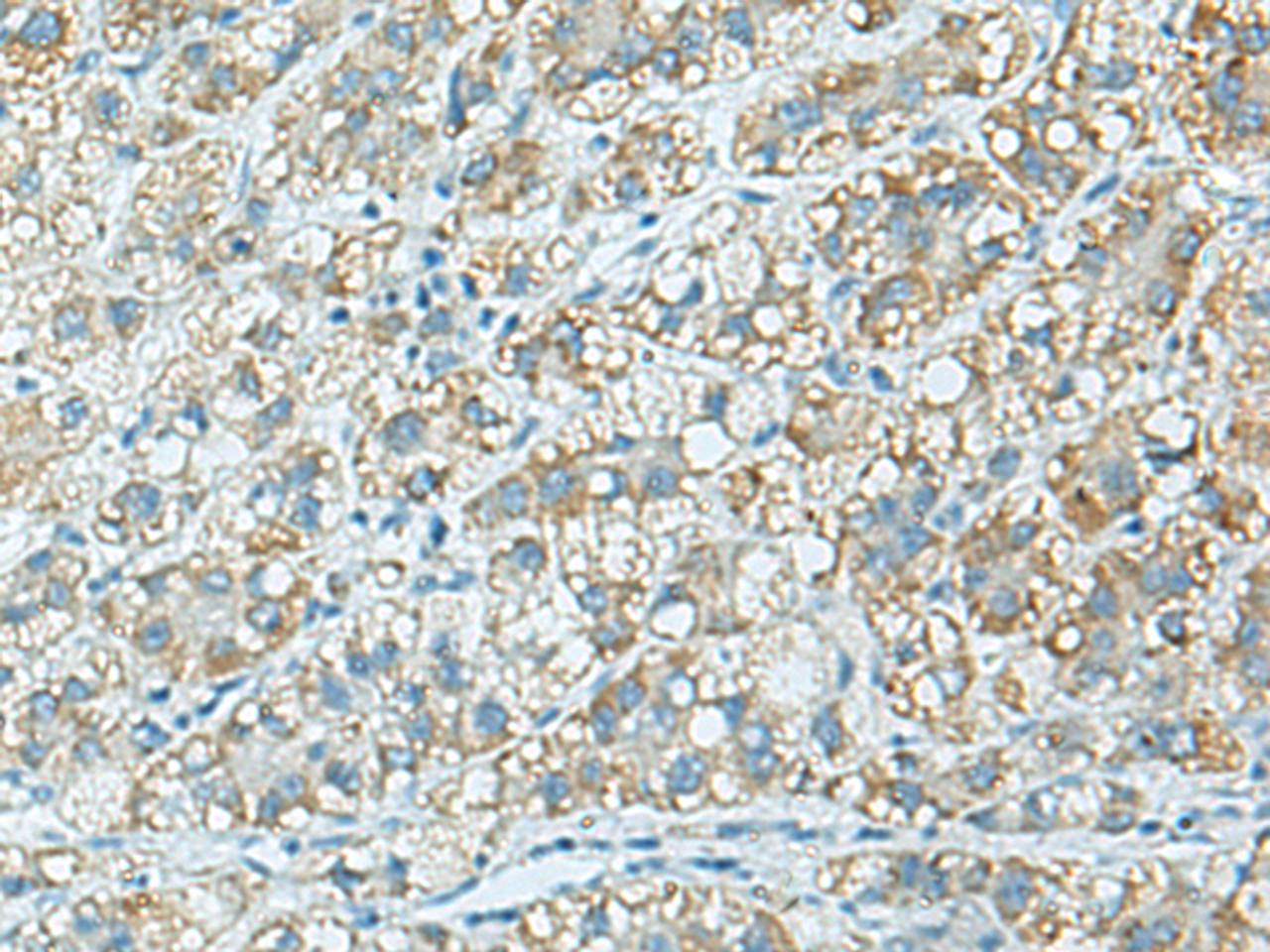 Immunohistochemistry of paraffin-embedded Human liver cancer tissue  using C3AR1 Polyclonal Antibody at dilution of 1:100(×200)