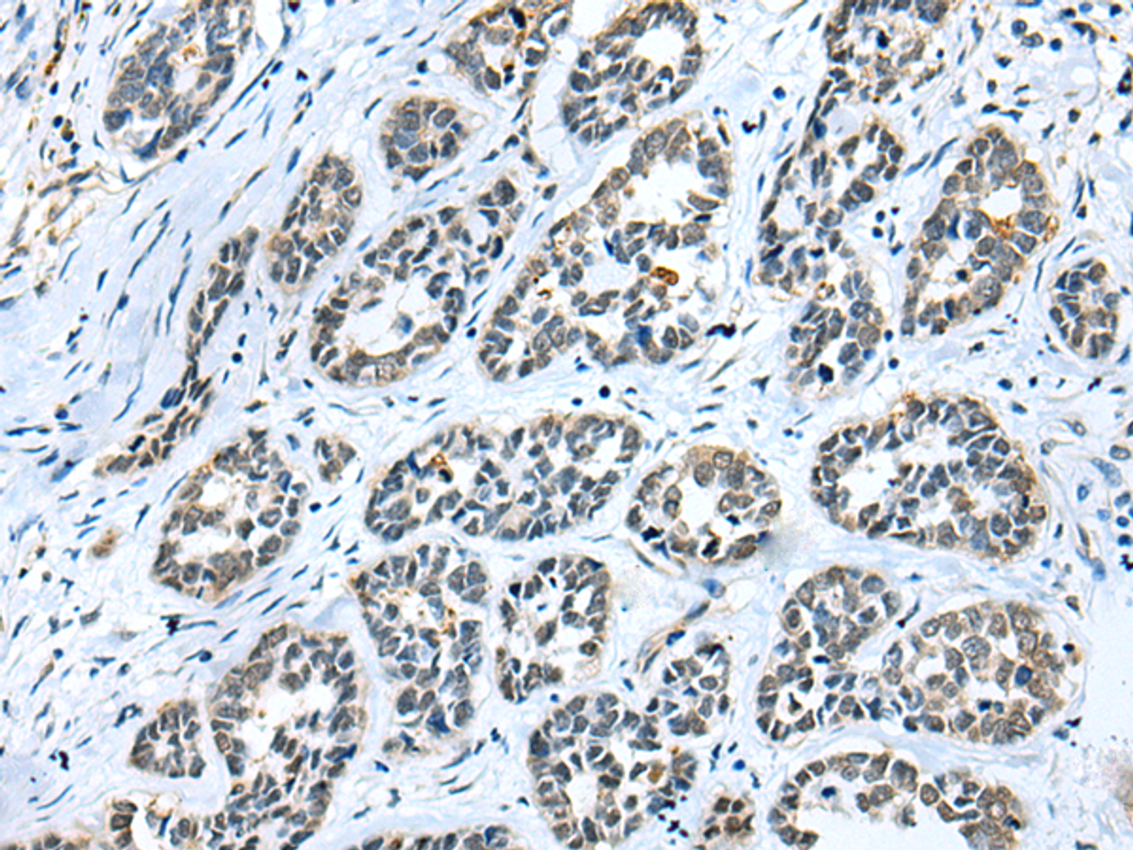 Immunohistochemistry of paraffin-embedded Human esophagus cancer tissue  using GMFB Polyclonal Antibody at dilution of 1:25(×200)