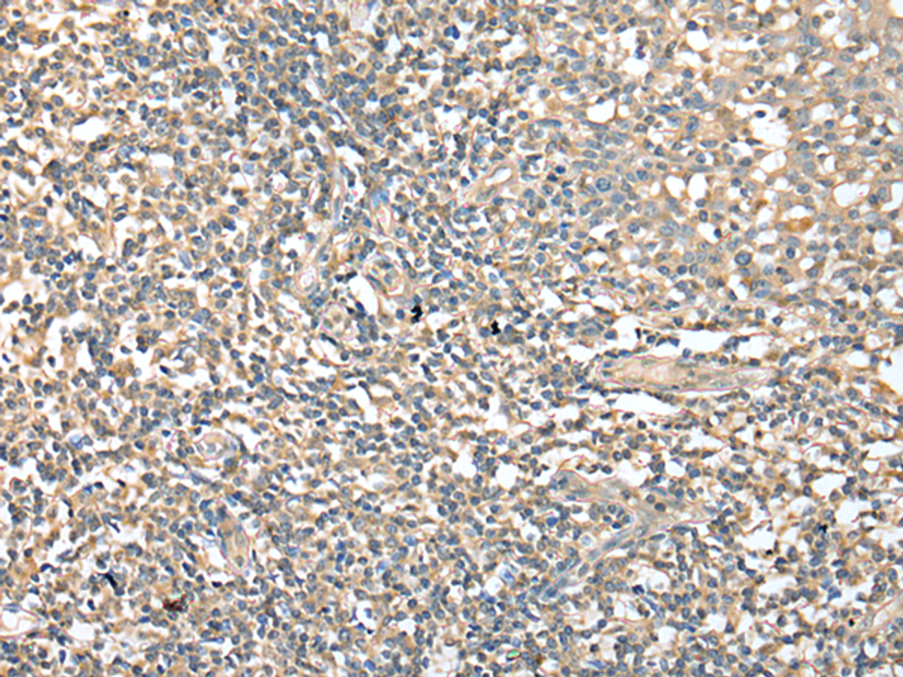 Immunohistochemistry of paraffin-embedded Human tonsil tissue  using CD1D Polyclonal Antibody at dilution of 1:25(×200)