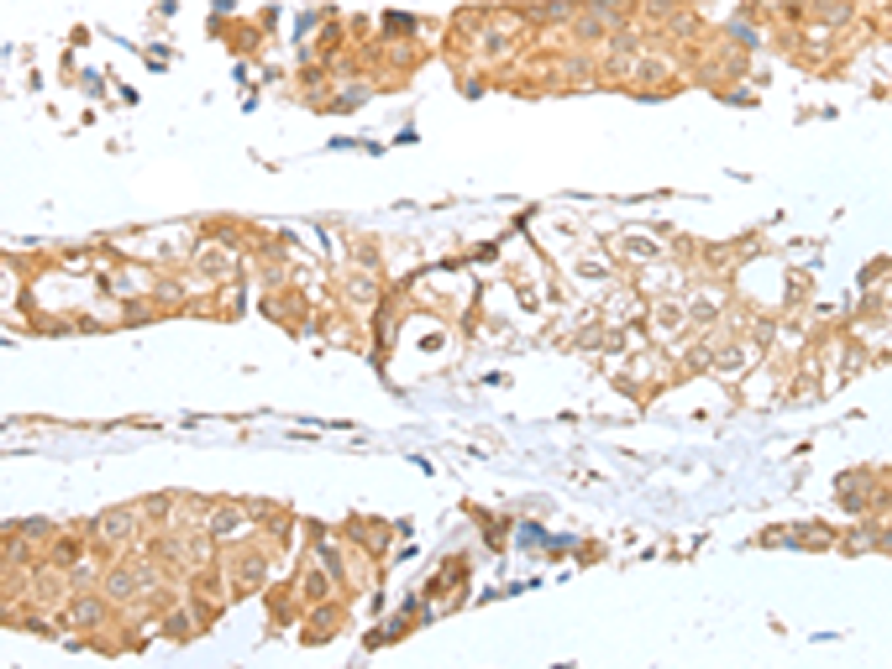 Immunohistochemistry of paraffin-embedded Human breast cancer tissue  using GLIPR1L1 Polyclonal Antibody at dilution of 1:25(×200)