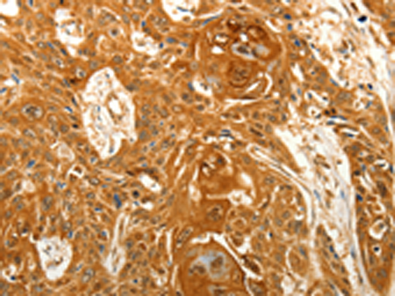Immunohistochemistry of paraffin-embedded Human esophagus cancer tissue  using VSNL1 Polyclonal Antibody at dilution of 1:25(×200)