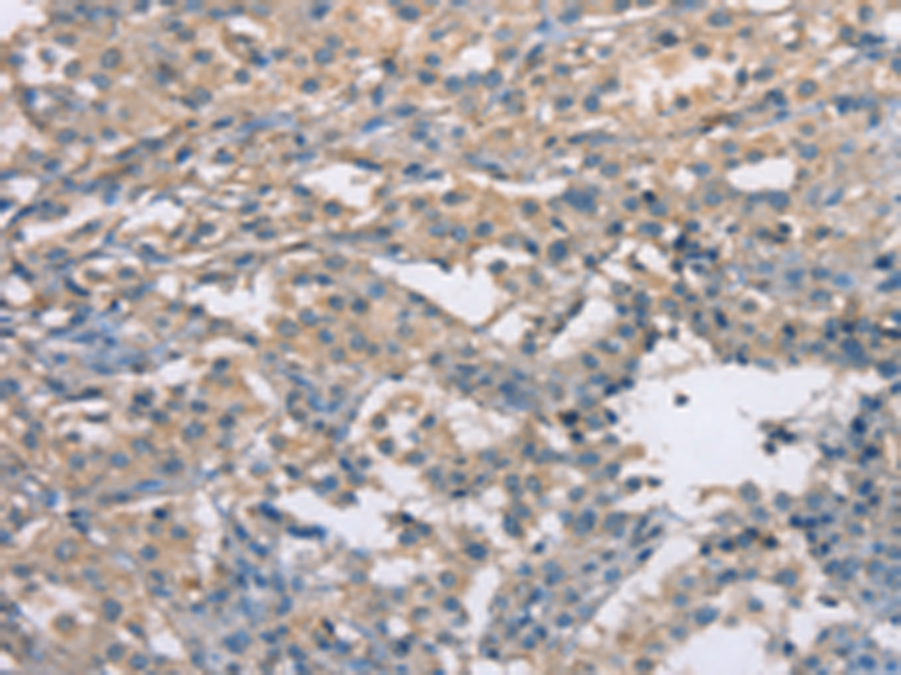 Immunohistochemistry of paraffin-embedded Human thyroid cancer tissue  using ZBP1 Polyclonal Antibody at dilution of 1:50(×200)