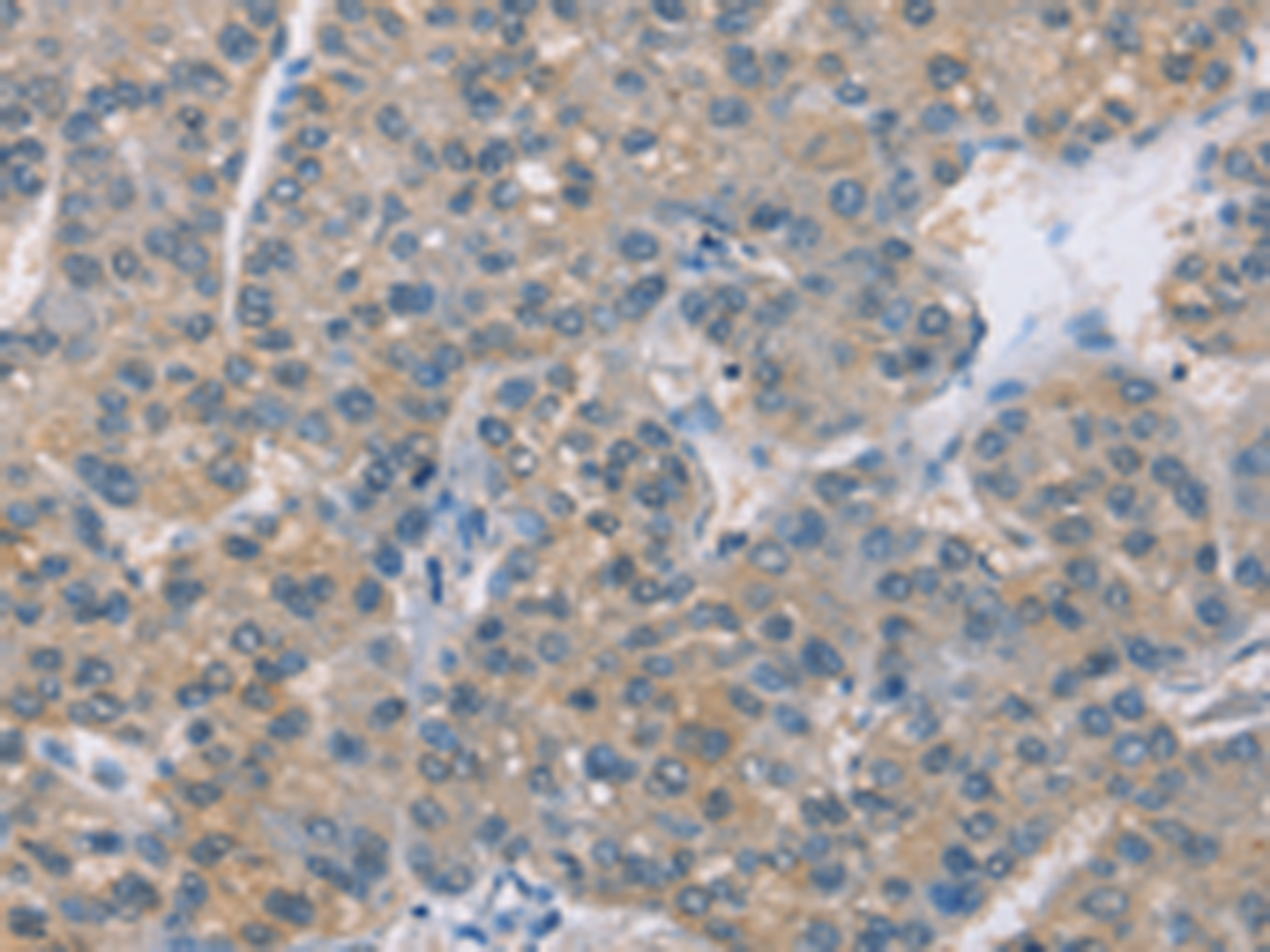 Immunohistochemistry of paraffin-embedded Human liver cancer tissue  using ZBP1 Polyclonal Antibody at dilution of 1:50(×200)