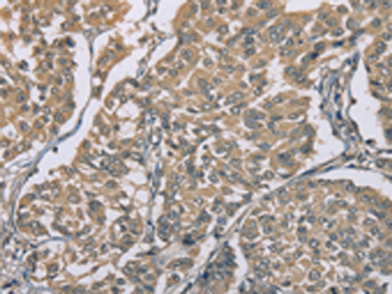 Immunohistochemistry of paraffin-embedded Human breast cancer tissue  using ZBTB2  Polyclonal Antibody at dilution of 1:50(×200)