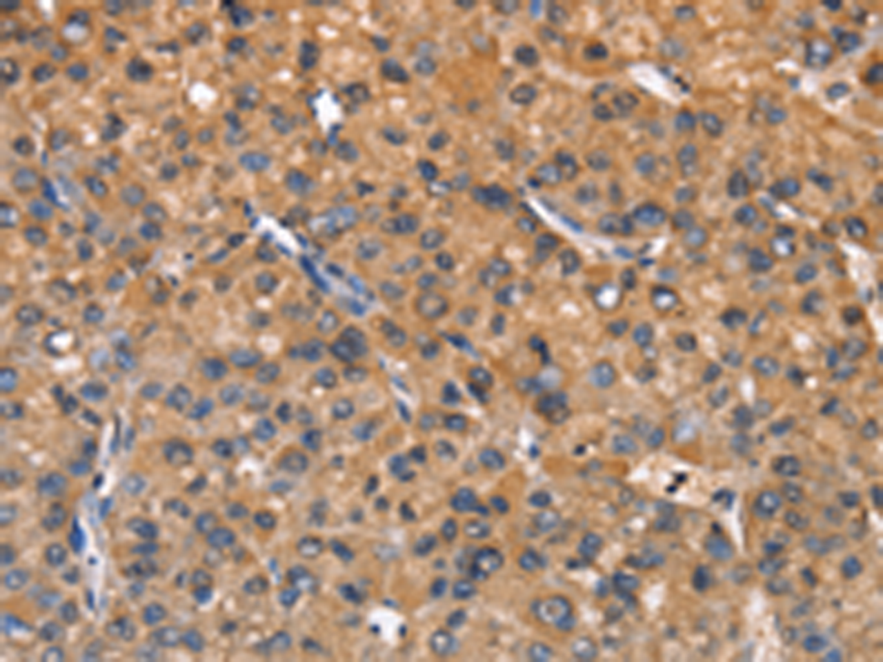 Immunohistochemistry of paraffin-embedded Human liver cancer tissue  using ZFP64  Polyclonal Antibody at dilution of 1:60(×200)