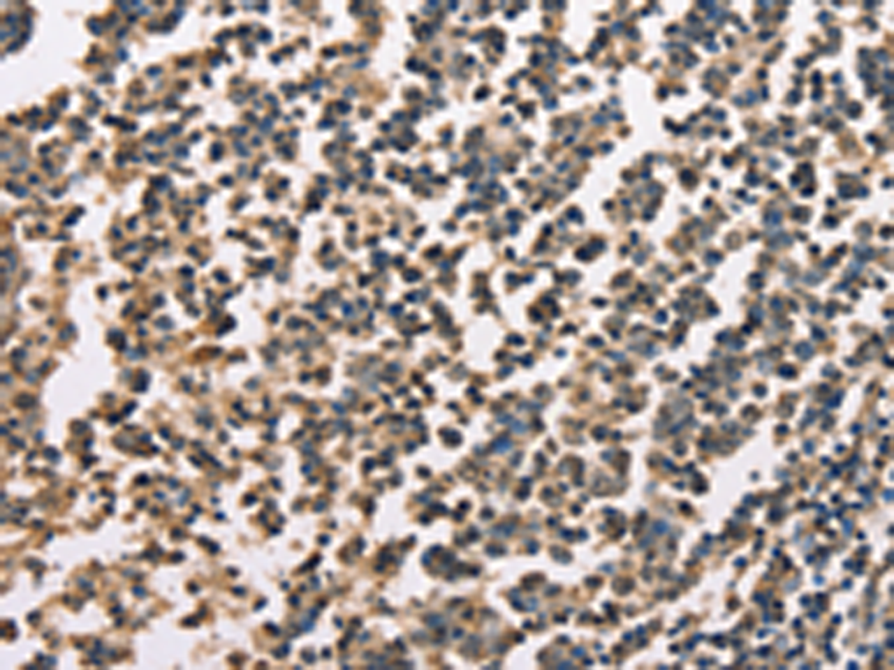 Immunohistochemistry of paraffin-embedded Human tonsil tissue  using ZFYVE19  Polyclonal Antibody at dilution of 1:60(×200)